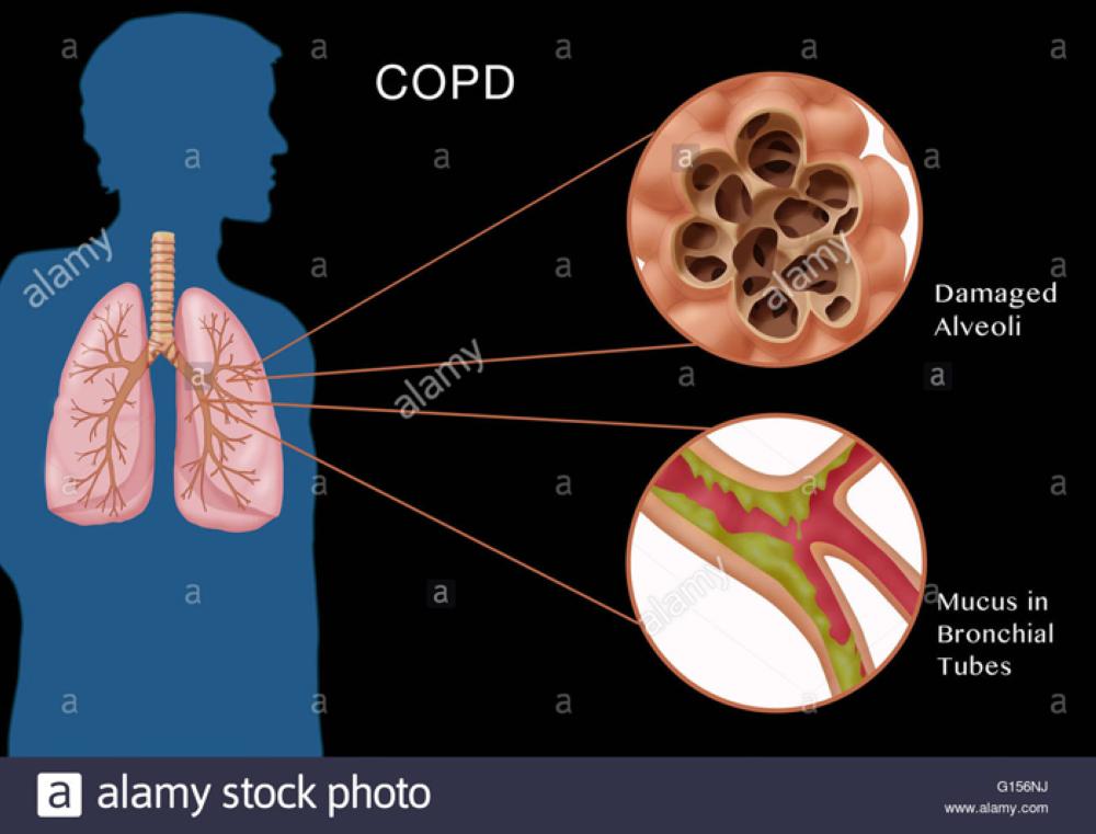 Preventing flare-up incidence in  people with COPD is critical to survival