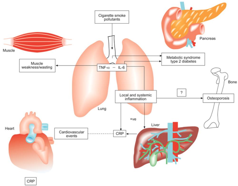 Preventing flare-up incidence in  people with COPD is critical to survival