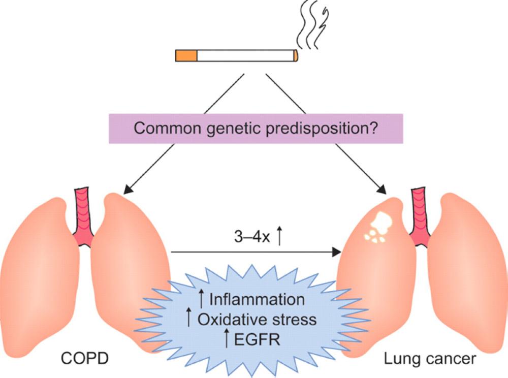 Preventing flare-up incidence in  people with COPD is critical to survival