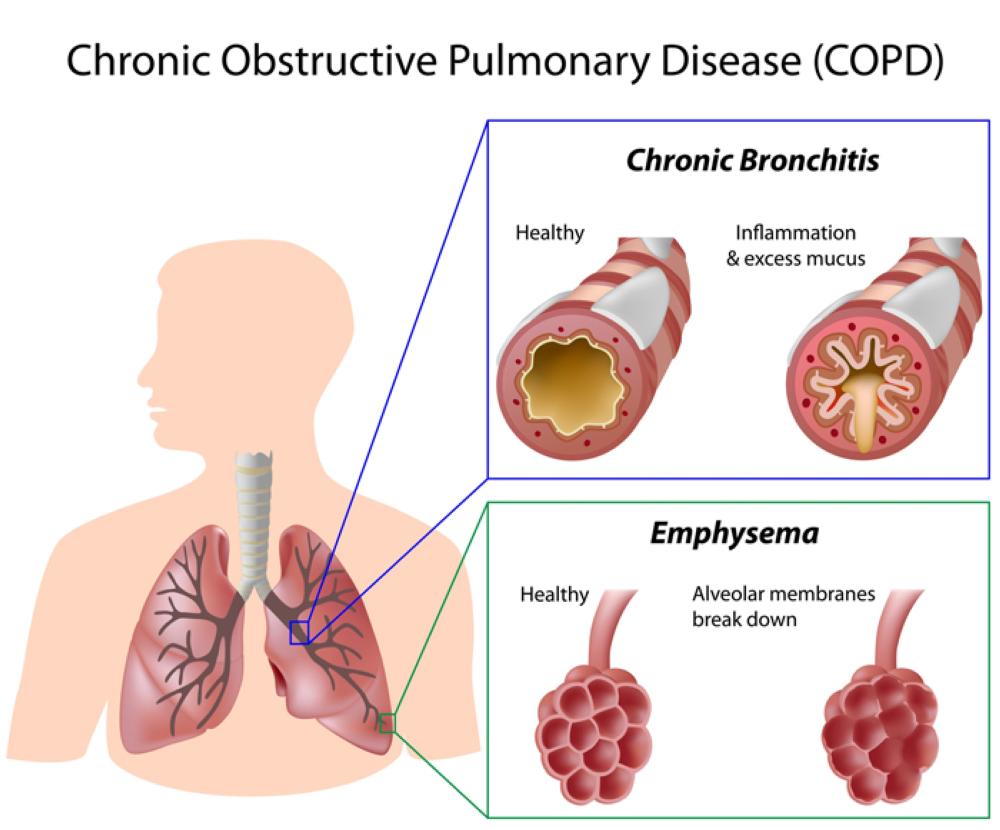 Preventing flare-up incidence in  people with COPD is critical to survival