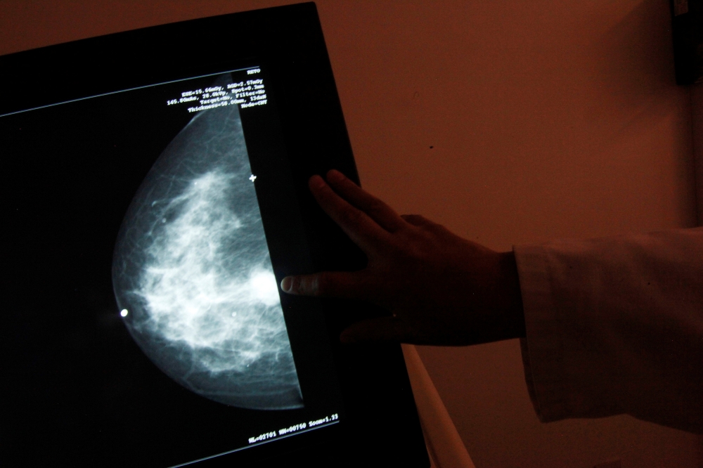 A monitor shows the image of a breast cancer at a center run by the “Reto” Group for Full Recovery of Breast Cancer in Mexico City in this Oct. 18, 2012 file photo. — Reuters