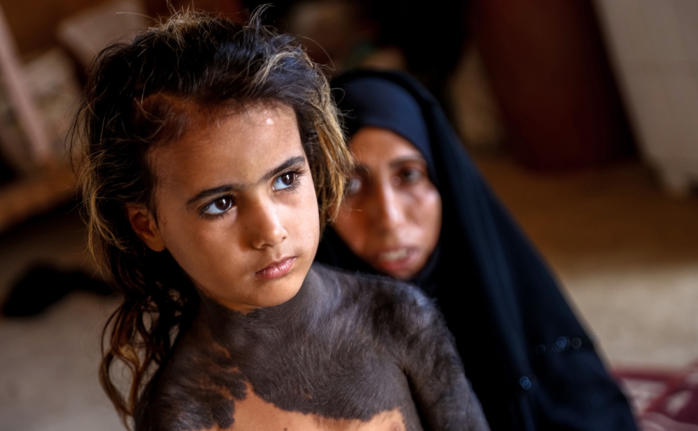 Haura, a four-year-old Iraqi child with a rare skin congenital disease that covers much of her upper body in black marks and hair, looks on as she stands in front of her mother in her family home in the village of Wahed Haziran, Diwaniya province. — AFP