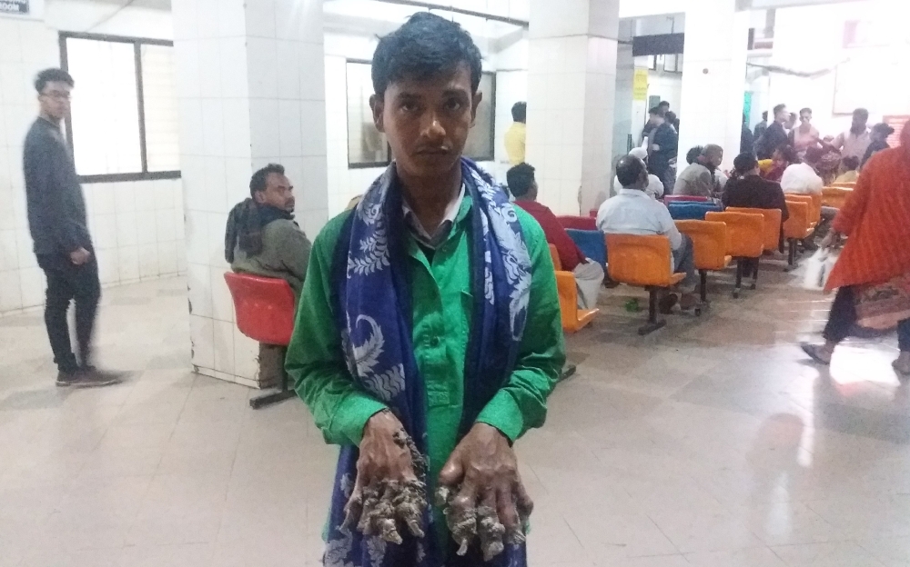 Abul Bajandar, center, returns to a Dhaka hospital on Monday, as bark-like growths on his hand keep increasing. — AFP