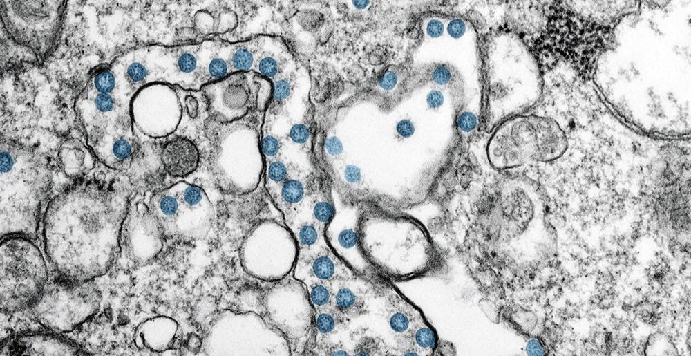 A digitally-enhanced microscopic image shows a coronavirus infection in blue of the first case discovered in the United States. — courtesy photo
