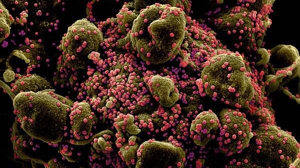 Colorized scanning electron micrograph of an apoptotic cell infected with coronavirus particles. — Courtesy photo