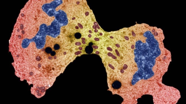 A scan showing bone cancer.