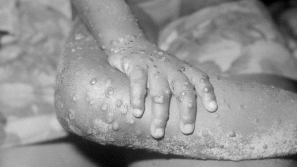 Symptoms of monkeypox include a rash, fever, headache, muscle aches, backache, swollen lymph nodes, chills and exhaustion.
