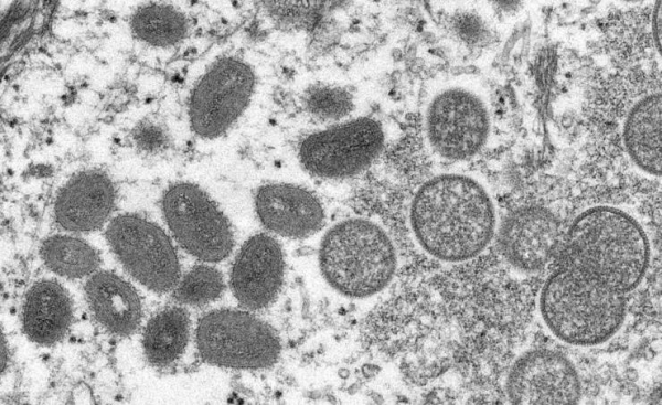 Spain's monkeypox case tally rises to 186
