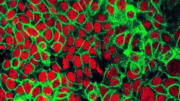 File photo of human colon cancer cells with the cell nuclei stained red and the protein E-cadherin stained green. — courtesy NCI Center for Cancer