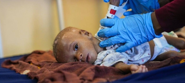 Eight-month-old Ibrahim, who is suffering from malnutrition, has his arm circumference measured by a doctor at a hospital in Mogadishu, Somalia.