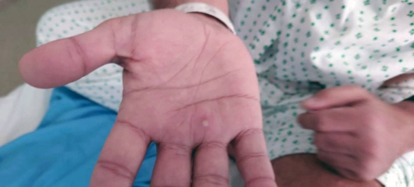The monkeypox virus can be spread through direct exposure to lesions. — courtesy Harun Tulunay