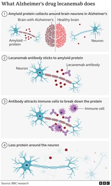 Alzheimer's drug hailed as momentous breakthrough