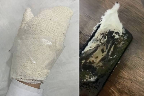 Saudi girl sustains burns as mobile phone catches fire