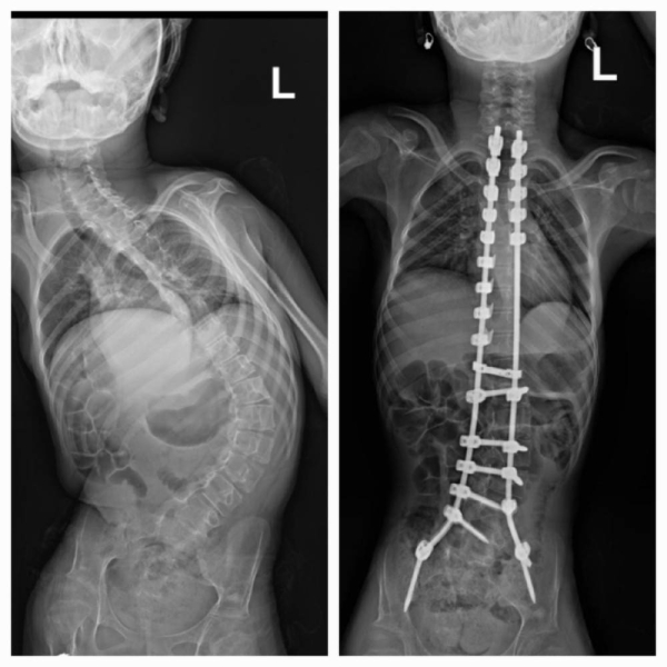 A great success for Dallah Hospital Al-Nakheel in treating various cases of spinal deformities