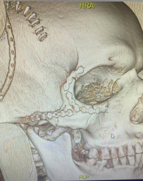 A Saudi medical team, specialized in maxillofacial surgery, has succeeded in reconstructing the fractured cheekbone of a young expatriate through a four-hour long surgery. 