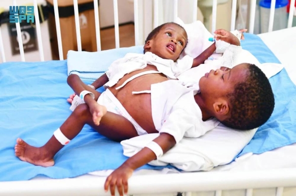 Tanzanian conjoined twins — Hassan and Hussein Omari Saidi — will undergo surgical separation in Riyadh on Thursday.