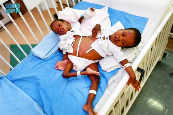 Tanzanian conjoined twins — Hassan and Hussein Omari Saidi — will undergo surgical separation in Riyadh on Thursday.