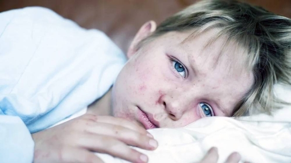 File photo of young boy with measles. — courtesy Getty Images