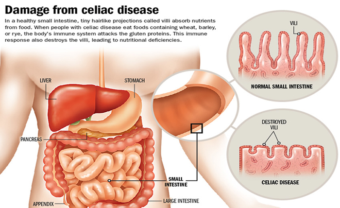 Saudi study confirms cardiac dysfunction in celiac children